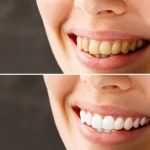 teeth whitening before and after what results can i expect