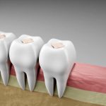 how dental fillings help save your tooth